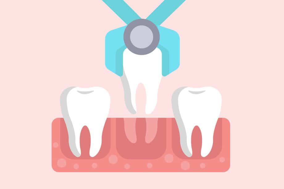 How bad does a tooth need to be before its extracted blog 920x613