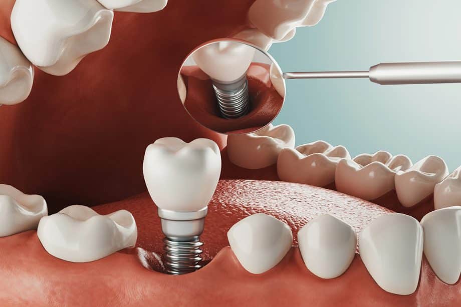 Am i a candidate for dental implants blog 920x613