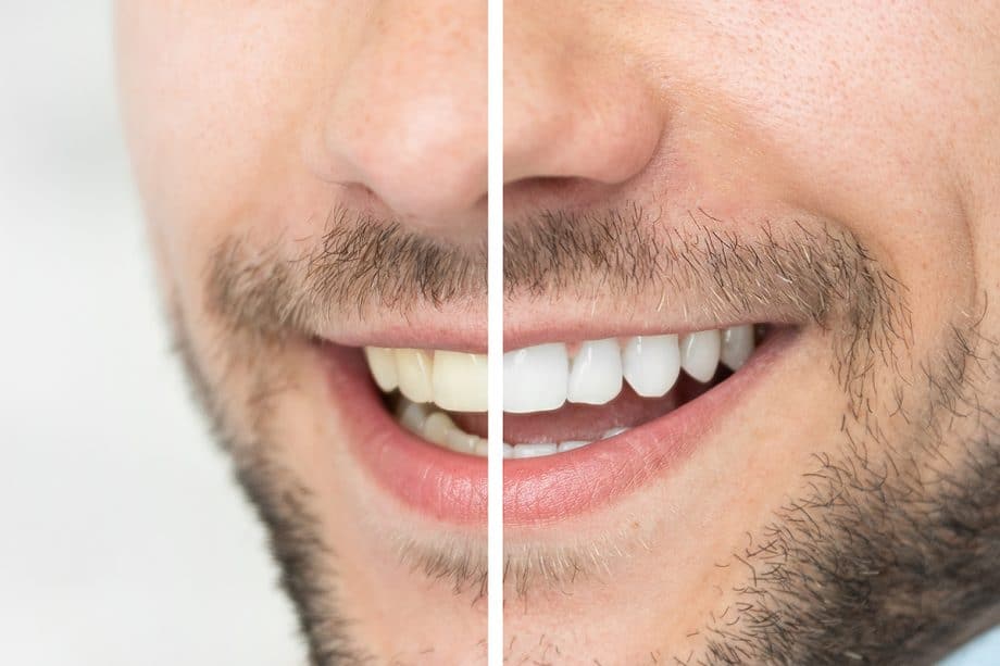 Do teeth whitening strips work 920x613