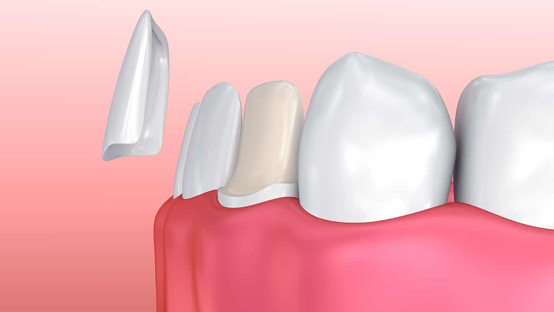 Veneers