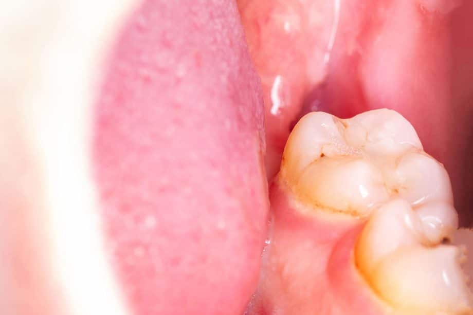 What is a dry socket after a tooth extraction blog 920x613